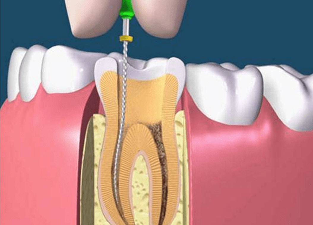 根管治療